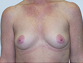 Patient # 65140 Before Photo # 1